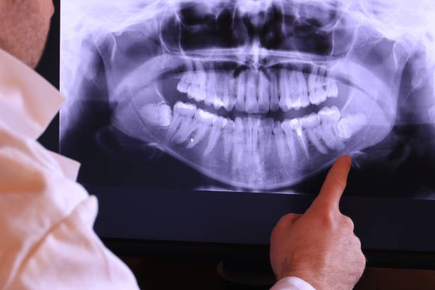 Best Emergency Wisdom Teeth Removal in Hauppauge, NY
